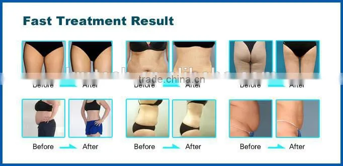 non-invasive lipo cavitation fat+diode lipo for fast slimming