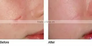 2012 hottest vibrating derma roller-L007 ce approval OEM