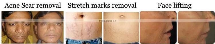 OEM service Professional portable fractional rf microneedle therapy machine for acne scars