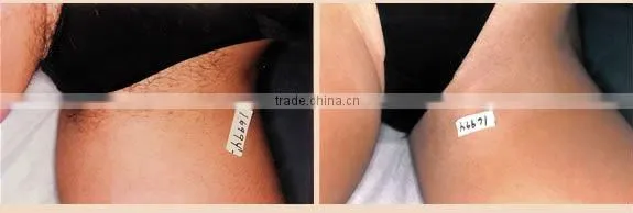 Portable IPL Machine(Huamei)