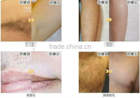 IPL RF Laser beauty equipment