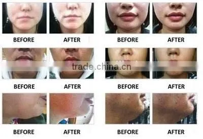 2014 fashionable elastic and durable neoprene v shape lifting slim face mask