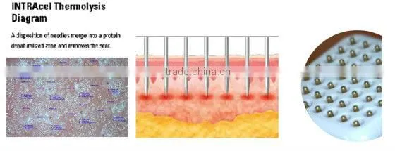Top performance!!!! microneedle skin treatment portable fractional rf