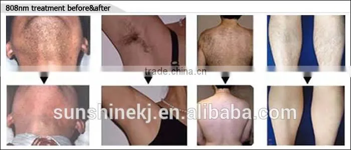 2017 Professional 808 Diode Laser For Permanent Hair Removal(CE approval)
