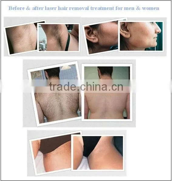 Distributors wanted Medical Q-switche laser 1064nm ND YAG home alexandrite laser hair removal machine