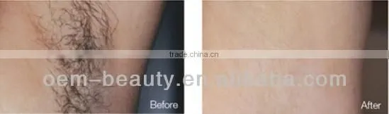 Sale! Intese pulse ipl laser machine hair reduction ipl machine