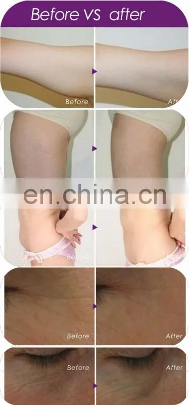 cavitation machine/ultrasonic cavitation rf slimming/cavitacion/cavitacao
