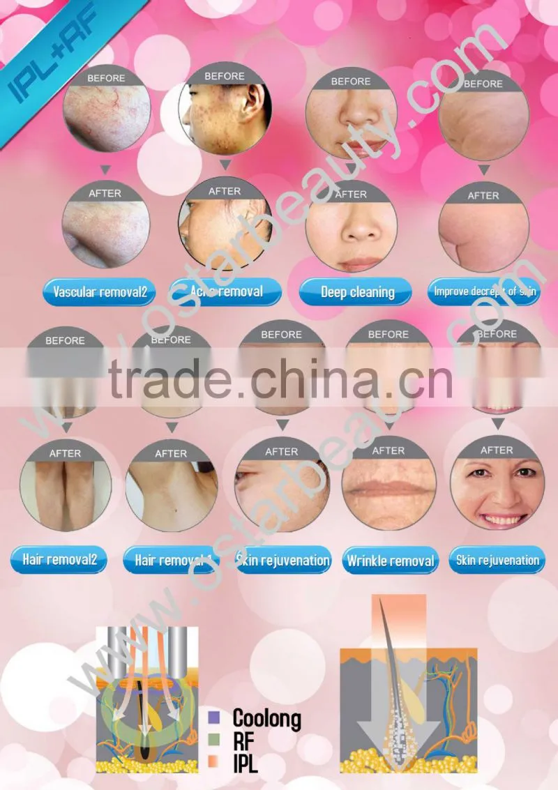2 in 1 elight ipl rf face lifting beauty care equipment E 03