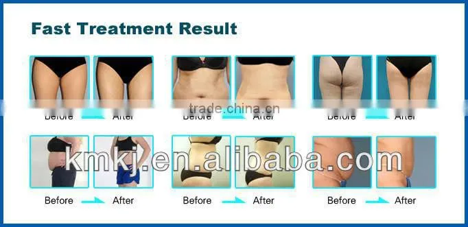 elight ipl rf shr laser multifunction hair removal equipment