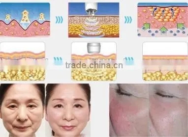 vacuum +bipolar rf + 40k ultrasonic cavitation + sextuple rf slimming machine