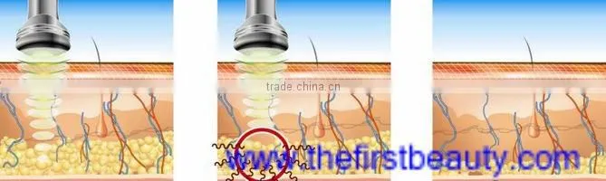 2016 hot sale effective& powerful cavitation vacuum rf machine No.F017