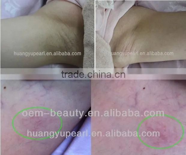 Dramatic changes permanent hair removal/onychomycosis therapy machine with long pulsed yag laser (CEapproval)for salon