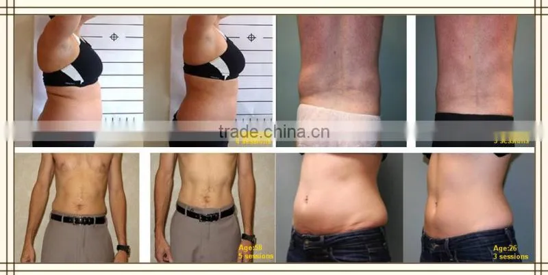 2015 Cryolipolysis cavitation rf slimming fat freezing cool shaping machine