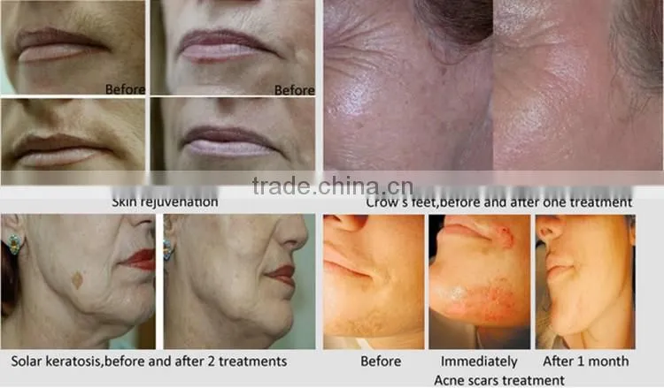 2016 hot selling spa water oxygen jet peel anti-aging facial treatment machine for sale
