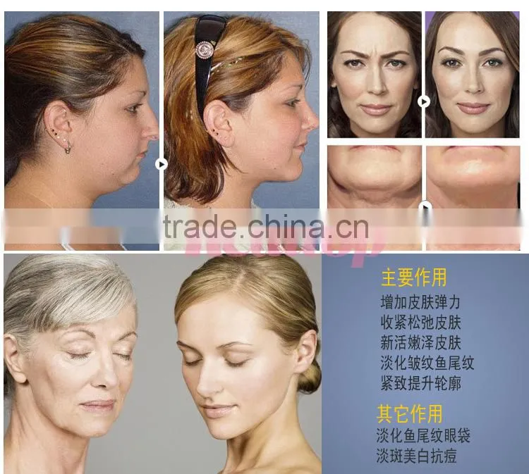 Bottom Price!!!Anti Wrinkle Treatment RF Skin Tightening Non Surgical Face Lift Machine