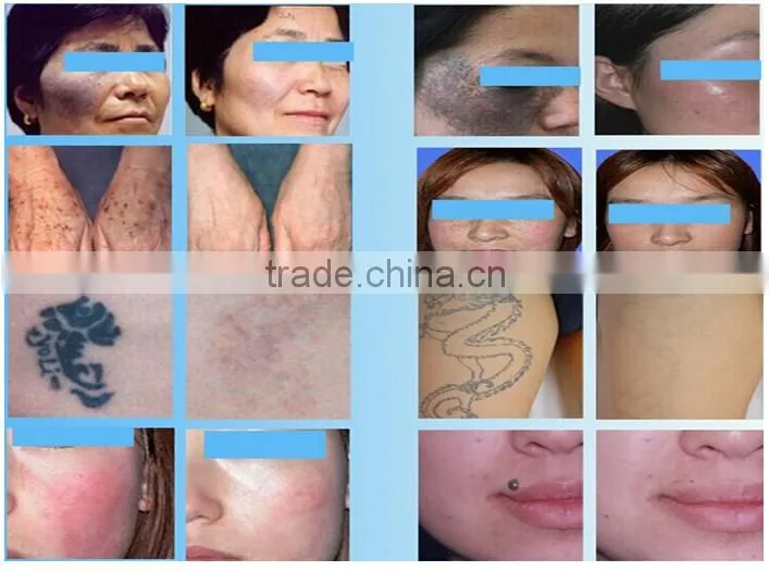ND YAG Laser for Tattoo Removal/Beauty Salon Equipment/nd yag laser tattoo removal machine spare parts