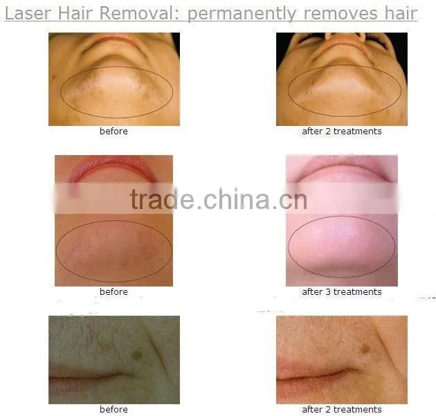 alma laser hair removal machine for sale