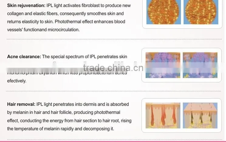 2015 mini ipl portable machine/hair removal ipl portable factory price