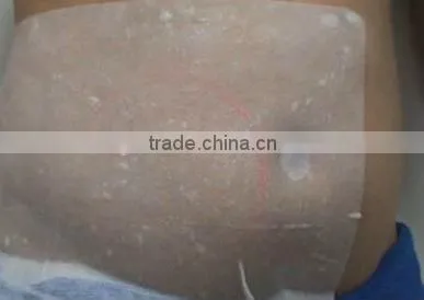 cryotherapy anti freeze membrane