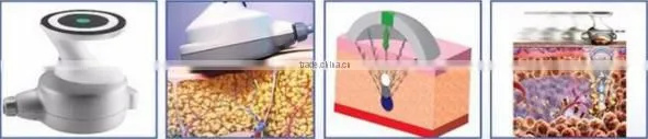 Permanent Body Slimming Ultrashape/Best slimming machine Ultrashape/High Quality Ultrashap machine for salon