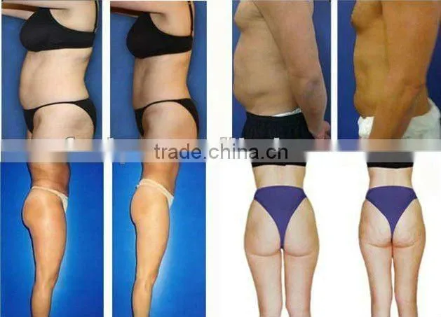 VY-Q2 Hottest Lipocavitation Slimming Machine