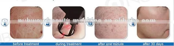 Medical CE FDA Approved Fractional co2 laser for facial resurfacing and ance scars