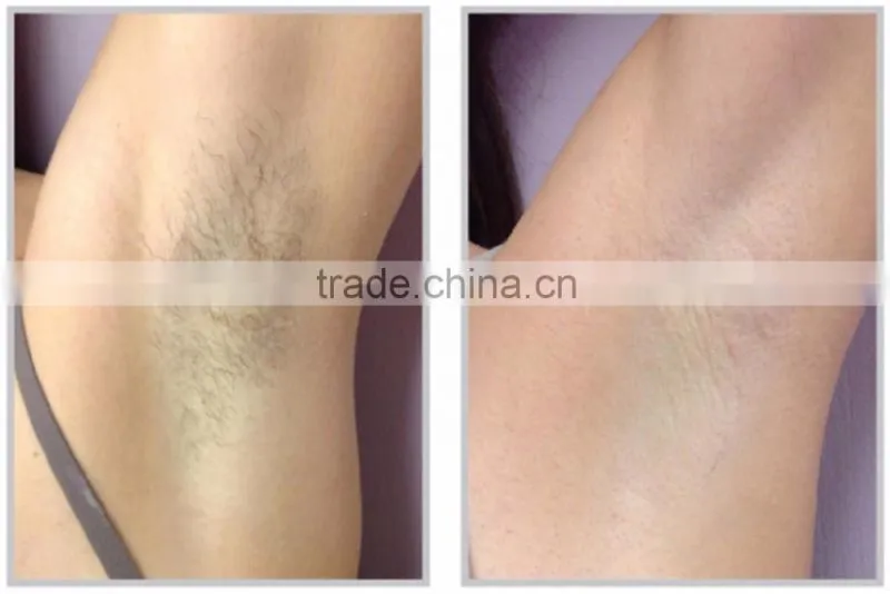 3in1 hair removal, shr laser IPL Nd Yag laser beauty machine
