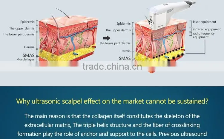2016Fashion smartsonic hifu ultrasound for skin lifting