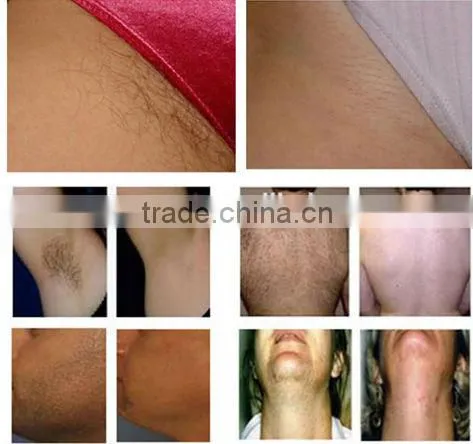 Professional hair removal multifunctional e-light instrument