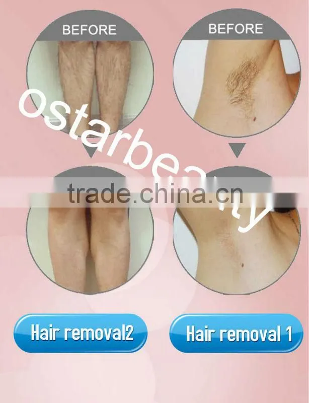 CE Approval 808 nm home laser Hair removal For Body , Face etc. hair removal DH 04