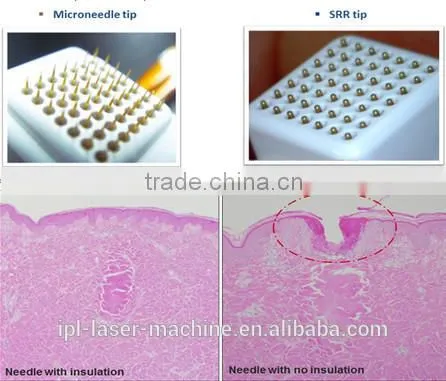 best China manufacturer factory direct sale price! portable microneedle fractional rf nubway