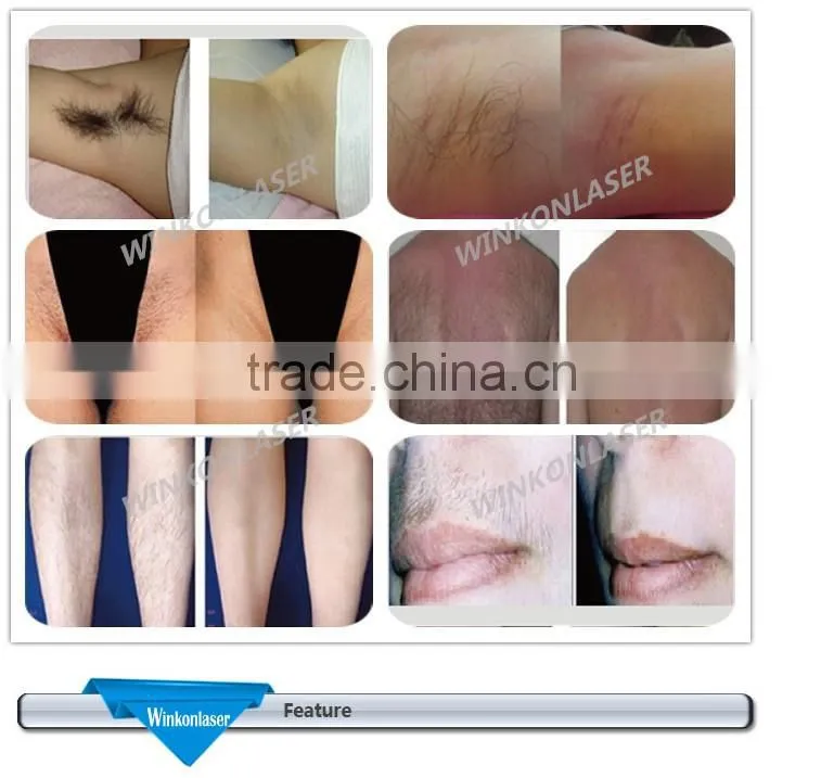 nono pro hair removal/diode laser hair removal