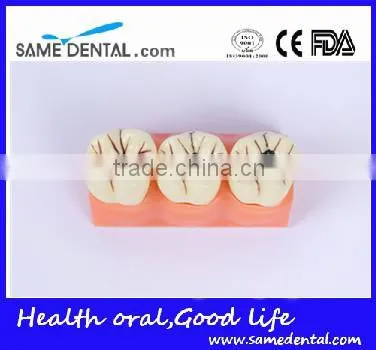 4 times the cavities progress model Dental Eduction Assitant No. DEA-16