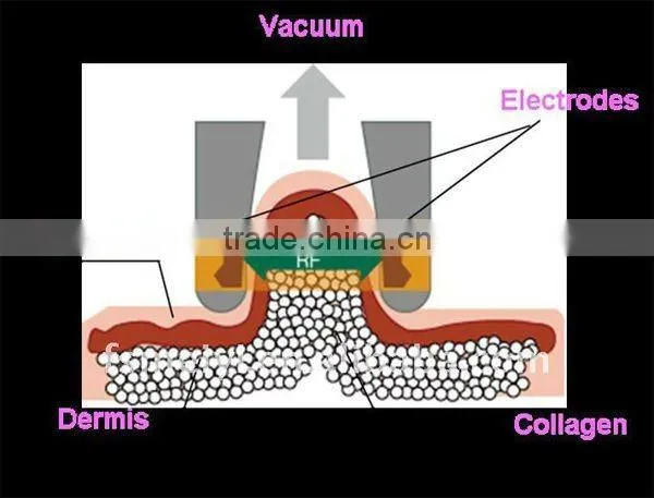 Tripolar Cavitation Vacuum Slimming for body and face B-5000