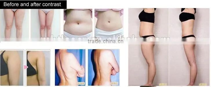 Ultrasonic RF vacuum Cavitation Slimming Machine