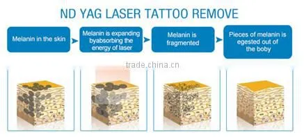 NEW technology High power hair removal e-light ipl rf nd yag laser multifunction machine