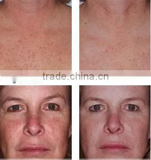 Remove broken veins ipl machine price