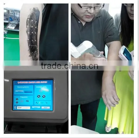 laser tattoo removal/q-switched laser price pigment tattoo removal/q switched nd yag eyebrow removal