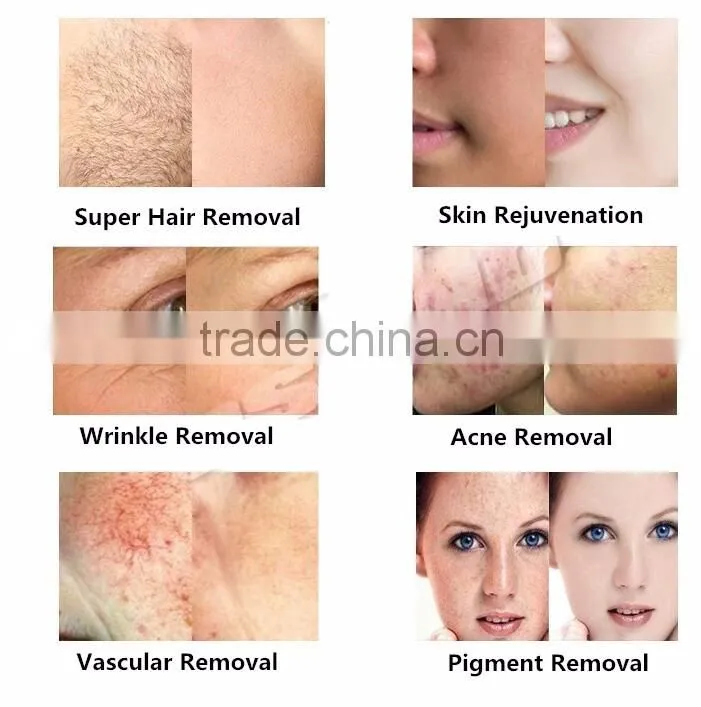 2017 Hot best ipl home machine elight ipl hair removal skin rejuvenation ipl rf