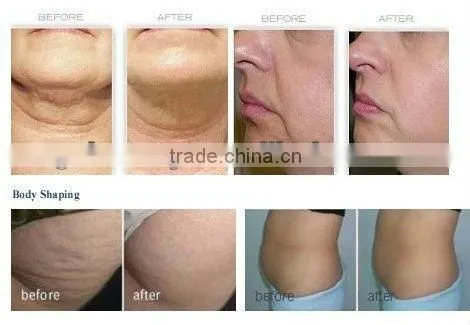 WL-07 Best rf skin tightening face lifting machine