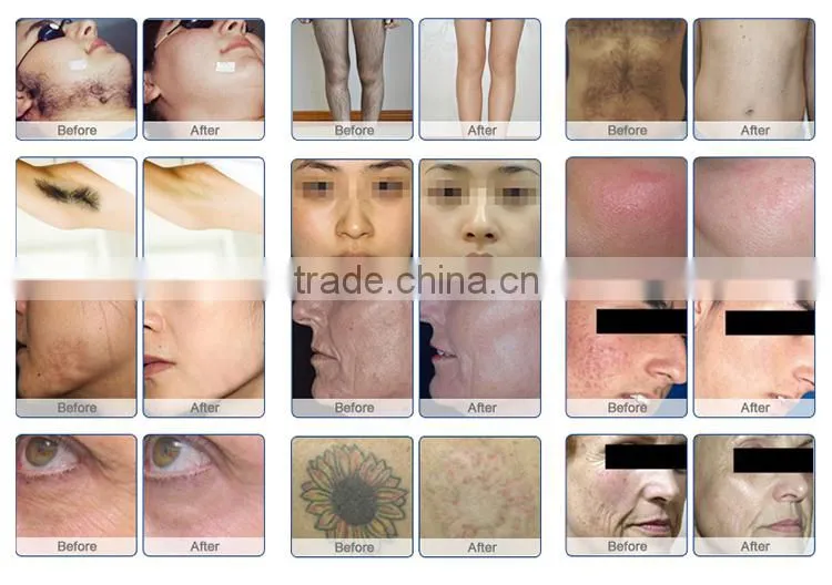 high quality ipl hair removal permanent machine