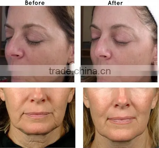 High Frequency Operation System and Anti-Puffiness/Skin Tightening/Wrinkle Remover Feature HIFU Face Lift