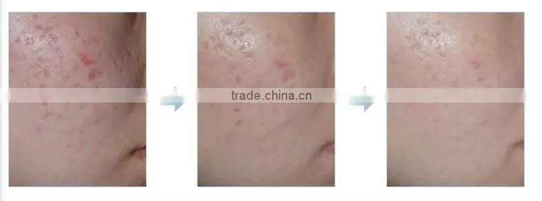 Microneedle therapy system dns derma roller L007