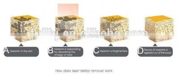 2015 Latest Technology Q-switched Nd Yag Laser Tattoo Removal/laser Tattoo Ink Remover