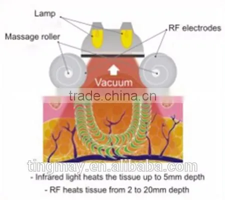 Vacuum RF Cavitation Infrared Laser Vacuum Roller Massage