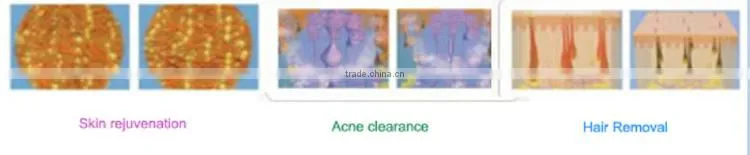 Best 3 in 1 male unwanted facial hair removal acne removal skin rejuvenation device for homeuse