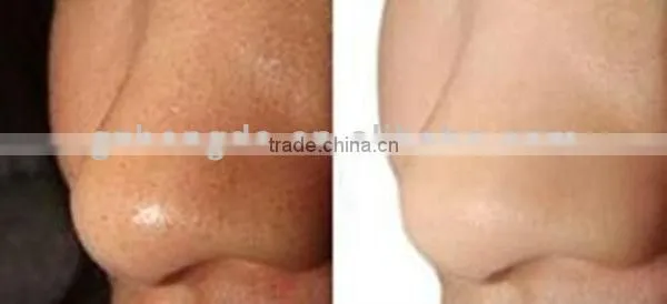 2013 Newest product! permanent lazer home hair removal device for the whole body BD-J005