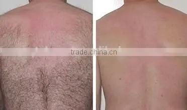 DCD cooling system Permanent 755nm/1064nm machine for men and women hair removal