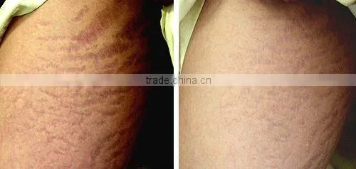 Micro needle LED Theory MT Titanium Derma Roller L004