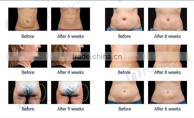 Full body cryotherapy best coolsculption results on abdomen